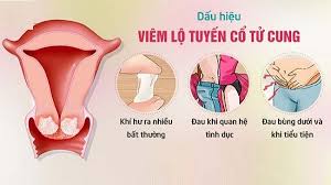 dấu hiệu của lộ tuyến cổ tử cung