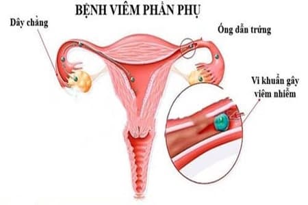 Triệu chứng của bị viêm nhiễm phần phụ