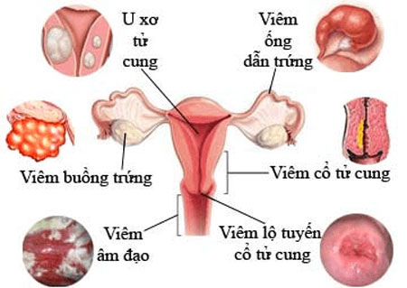 ​Những bệnh phụ khoa thường gặp ở phụ nữ